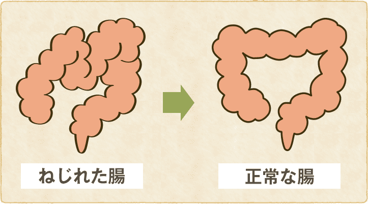 腸のねじれbeforeafterのイラスト